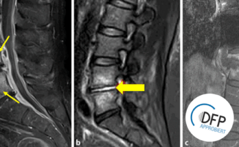 MRT-Bilder der Wirbelsäule bei Spondylodiszitis