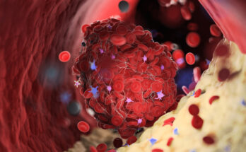 3d rendered medically accurate illustration of a thrombus emerging from a capped plaque